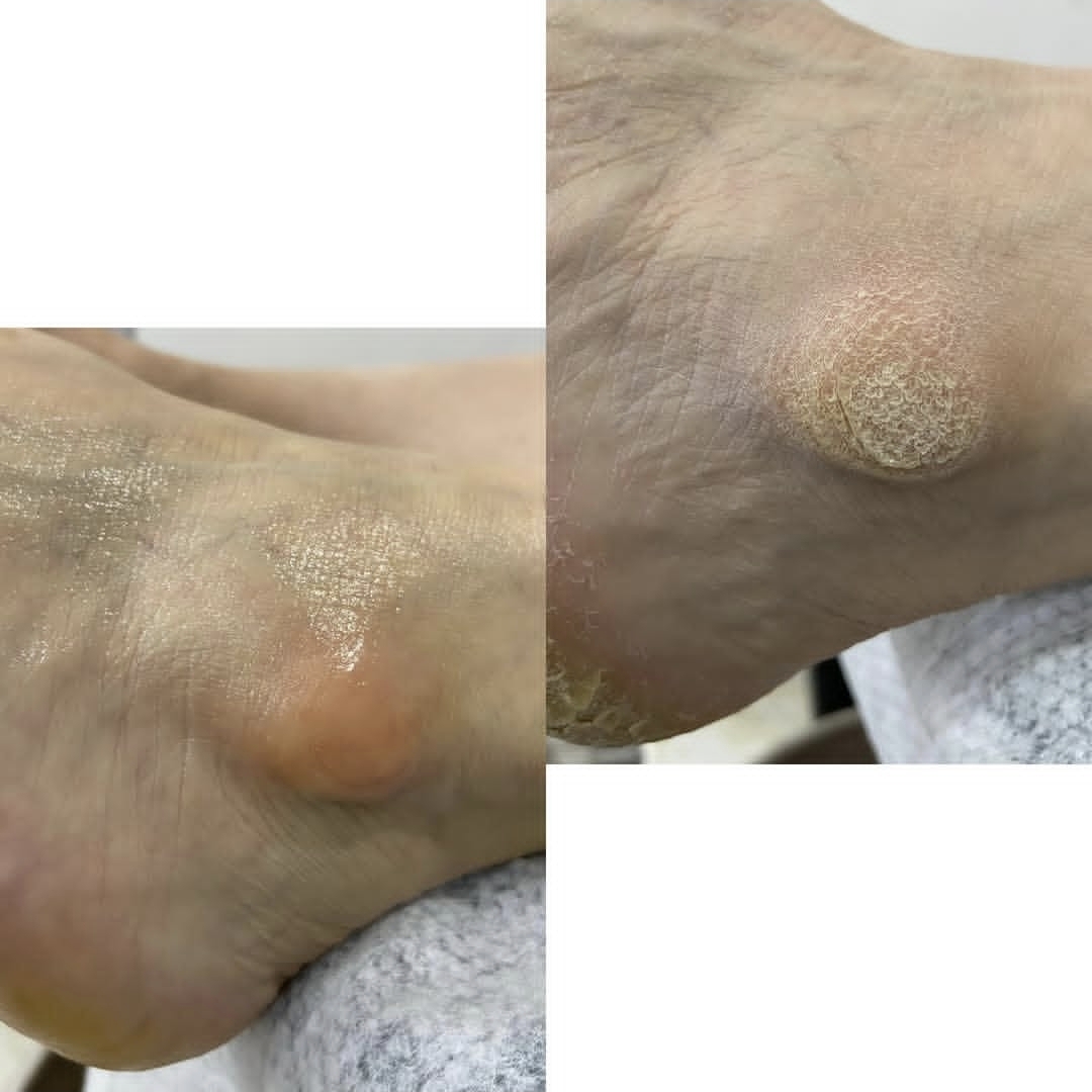 پدیکور درمانی کفسابی اسپا