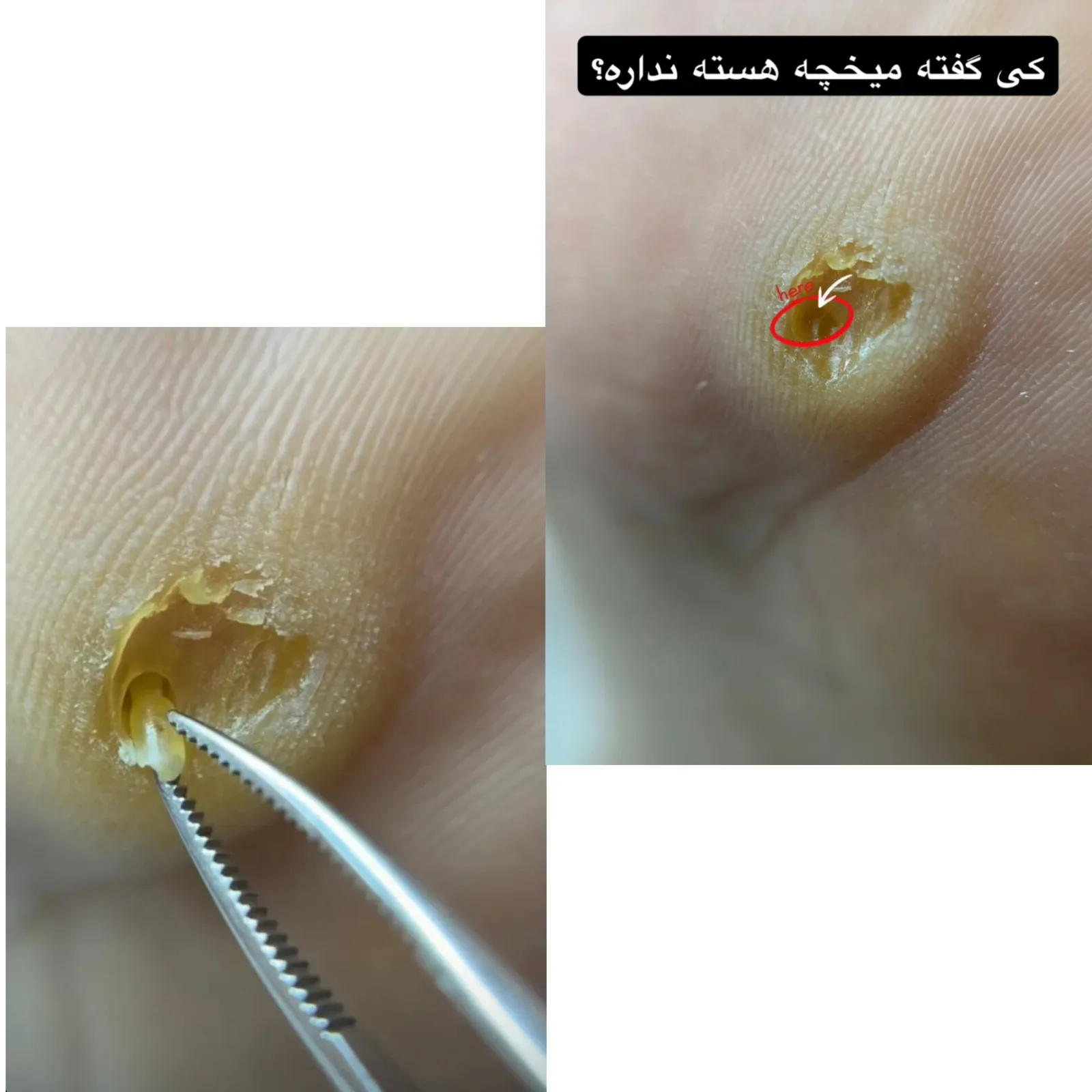 در آوردن میخچه بدون درد و خونریزی — کارِ اتنا در سالن زیبایی نیل تهرانپارس